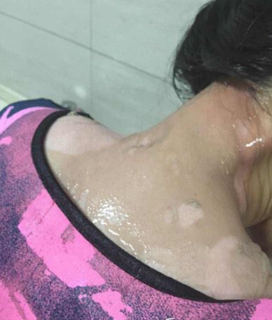 被浇女子除了生理上的痛,可能一辈子都要留下心理创伤 被浇女子除了生理上的痛,可能一辈子都要留下心理创伤